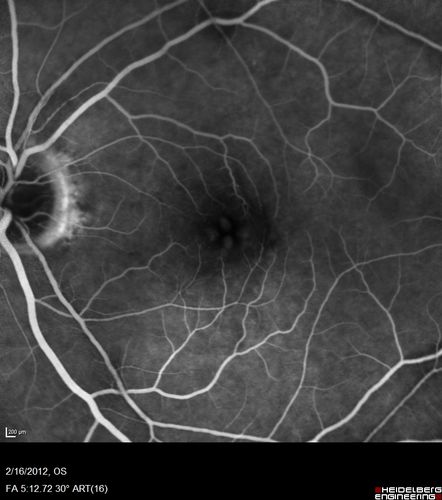 Vitreomacular traction - recent vision loss left eye - FA
