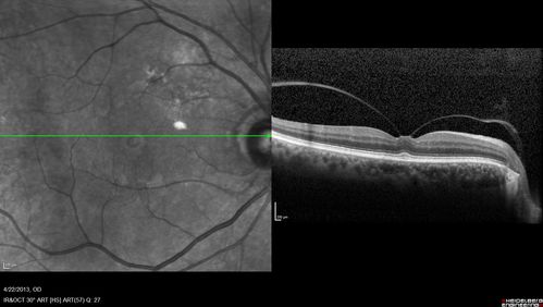 Vitreomacular traction - recent vision loss Right Eye 
