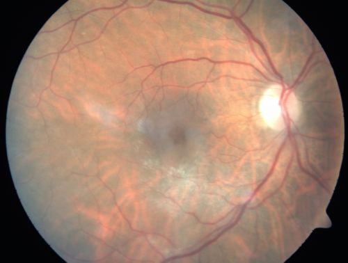 Vitreomacular Traction - Macular Pucker - 20/50 Vision
75-year-old woman decreasing vision in the right eye a few months ago.  She had her cataract removed and unfortunately her vision is still hazy in the right eye.  Her left eye seems a little hazy from the cataract.

VISUAL ACUITY:  OD 20/50, OS 20/20.  IOP: OD 17, OS 18. 
SLIT-LAMP EXAMINATION

