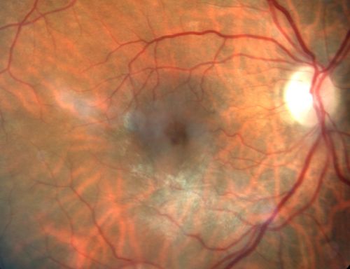 Vitreomacular Traction - Macular Pucker - 20/50 Vision
75-year-old woman decreasing vision in the right eye a few months ago.  She had her cataract removed and unfortunately her vision is still hazy in the right eye.  Her left eye seems a little hazy from the cataract.

VISUAL ACUITY:  OD 20/50, OS 20/20.  IOP: OD 17, OS 18. 
SLIT-LAMP EXAMINATION
