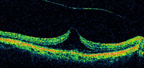 Vitreomacular Traction - Macular Pucker - 20/50 Vision
75-year-old woman decreasing vision in the right eye a few months ago.  She had her cataract removed and unfortunately her vision is still hazy in the right eye.  Her left eye seems a little hazy from the cataract.

VISUAL ACUITY:  OD 20/50, OS 20/20.  IOP: OD 17, OS 18. 
SLIT-LAMP EXAMINATION
