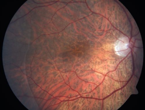 Vitreomacular traction with traction over retinal vessels in non-diabetic - Fluorescein leakage in areas of traction - Progressing vision loss left eye
80-year-old woman had vitrectomy surgery done in the right eye in 2007. Vision has been poor since despite a good anatomical result. Recently her vision in the left eye has been declining.  The vision has declined in the left eye. Vision OD is 20/160, OS is 20/80
