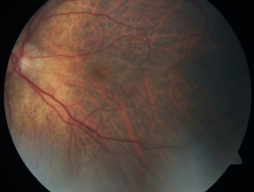 Vitreomacular traction with traction over retinal vessels in non-diabetic - Fluorescein leakage in areas of traction - Progressing vision loss left eye
80-year-old woman had vitrectomy surgery done in the right eye in 2007. Vision has been poor since despite a good anatomical result. Recently her vision in the left eye has been declining.  The vision has declined in the left eye. Vision OD is 20/160, OS is 20/80
