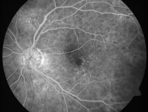 Vitreomacular traction with traction over retinal vessels in non-diabetic - Fluorescein leakage in areas of traction - Progressing vision loss left eye
80-year-old woman had vitrectomy surgery done in the right eye in 2007. Vision has been poor since despite a good anatomical result. Recently her vision in the left eye has been declining.  The vision has declined in the left eye. Vision OD is 20/160, OS is 20/80
