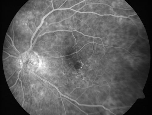 Vitreomacular traction with traction over retinal vessels in non-diabetic - Fluorescein leakage in areas of traction - Progressing vision loss left eye
80-year-old woman had vitrectomy surgery done in the right eye in 2007. Vision has been poor since despite a good anatomical result. Recently her vision in the left eye has been declining.  The vision has declined in the left eye. Vision OD is 20/160, OS is 20/80
