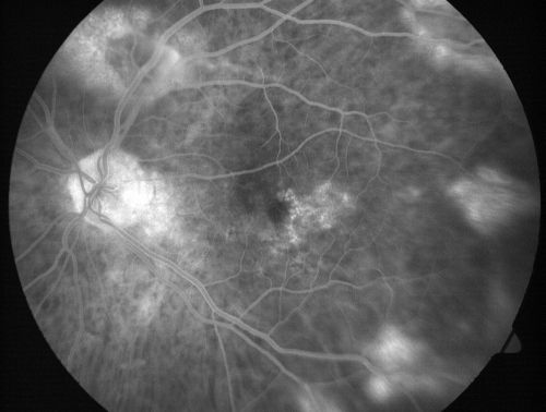 Vitreomacular traction with traction over retinal vessels in non-diabetic - Fluorescein leakage in areas of traction - Progressing vision loss left eye
80-year-old woman had vitrectomy surgery done in the right eye in 2007. Vision has been poor since despite a good anatomical result. Recently her vision in the left eye has been declining.  The vision has declined in the left eye. Vision OD is 20/160, OS is 20/80
