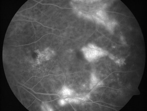 Vitreomacular traction with traction over retinal vessels in non-diabetic - Fluorescein leakage in areas of traction - Progressing vision loss left eye
80-year-old woman had vitrectomy surgery done in the right eye in 2007. Vision has been poor since despite a good anatomical result. Recently her vision in the left eye has been declining.  The vision has declined in the left eye. Vision OD is 20/160, OS is 20/80
