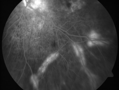 Vitreomacular traction with traction over retinal vessels in non-diabetic - Fluorescein leakage in areas of traction - Progressing vision loss left eye
80-year-old woman had vitrectomy surgery done in the right eye in 2007. Vision has been poor since despite a good anatomical result. Recently her vision in the left eye has been declining.  The vision has declined in the left eye. Vision OD is 20/160, OS is 20/80

