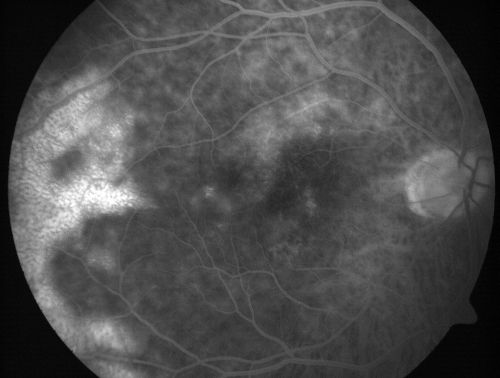 Vitreomacular traction with traction over retinal vessels in non-diabetic - Fluorescein leakage in areas of traction - Progressing vision loss left eye
80-year-old woman had vitrectomy surgery done in the right eye in 2007. Vision has been poor since despite a good anatomical result. Recently her vision in the left eye has been declining.  The vision has declined in the left eye. Vision OD is 20/160, OS is 20/80
