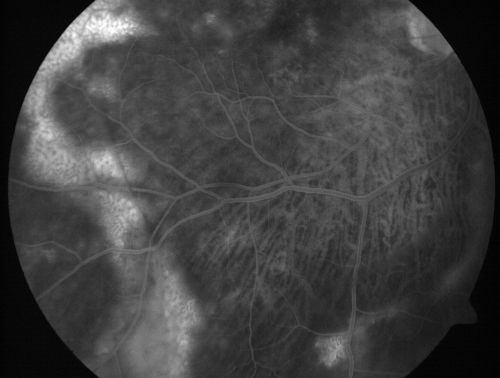 Vitreomacular traction with traction over retinal vessels in non-diabetic - Fluorescein leakage in areas of traction - Progressing vision loss left eye
80-year-old woman had vitrectomy surgery done in the right eye in 2007. Vision has been poor since despite a good anatomical result. Recently her vision in the left eye has been declining.  The vision has declined in the left eye. Vision OD is 20/160, OS is 20/80
