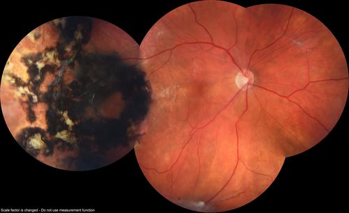 Hyperpigmented Vasoproliferative Tumor on Buckle with New Serous Retinal Detachment 20 years post RD Repair
67 year old female RD repair OU 1999 then severe (20/400) macular pucker OD removed 3 months later (twin sister also had bilateral RDâ€™s with PVR).  Then dislocated IOL surgery right eye 9/2012.  New vision loss in the right eye with serous retinal detachment.  Argon laser to dark tumor led to resolution of subretinal fluid within a month.

