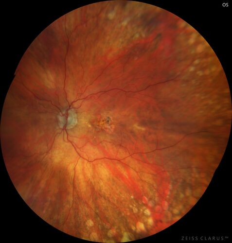 Asymptomatic exudative wet age-related macular degeneration
78 year old man with scar in the left eye being treated regularly and returns with new lesions in the right eye which is not symptomatic.  Vision is 20/25 right eye and 20/125 left eye.  The lesion was treated and responded to anti-VEGF therapy
