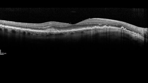 Asymptomatic exudative wet age-related macular degeneration
78 year old man with scar in the left eye being treated regularly and returns with new lesions in the right eye which is not symptomatic.  Vision is 20/25 right eye and 20/125 left eye.  The lesion was treated and responded to anti-VEGF therapy

