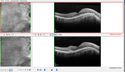 Asymptomatic exudative wet age-related macular degeneration
78 year old man with scar in the left eye being treated regularly and returns with new lesions in the right eye which is not symptomatic.  Vision is 20/25 right eye and 20/125 left eye.  The lesion was treated and responded to anti-VEGF therapy
