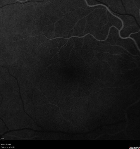 Asymptomatic exudative wet age-related macular degeneration
78 year old man with scar in the left eye being treated regularly and returns with new lesions in the right eye which is not symptomatic.  Vision is 20/25 right eye and 20/125 left eye.  The lesion was treated and responded to anti-VEGF therapy
