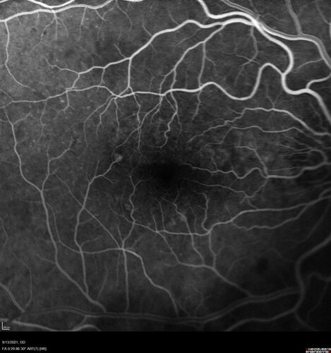 Asymptomatic exudative wet age-related macular degeneration
78 year old man with scar in the left eye being treated regularly and returns with new lesions in the right eye which is not symptomatic.  Vision is 20/25 right eye and 20/125 left eye.  The lesion was treated and responded to anti-VEGF therapy
