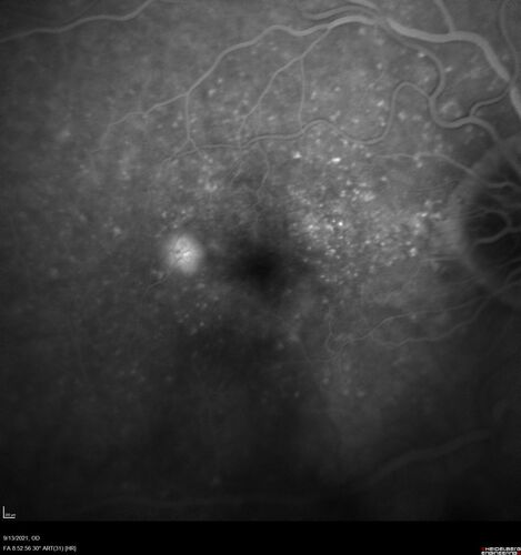 Asymptomatic exudative wet age-related macular degeneration
78 year old man with scar in the left eye being treated regularly and returns with new lesions in the right eye which is not symptomatic.  Vision is 20/25 right eye and 20/125 left eye.  The lesion was treated and responded to anti-VEGF therapy
