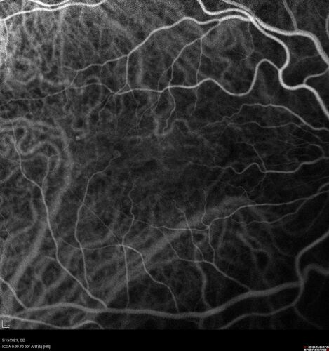 Asymptomatic exudative wet age-related macular degeneration
78 year old man with scar in the left eye being treated regularly and returns with new lesions in the right eye which is not symptomatic.  Vision is 20/25 right eye and 20/125 left eye.  The lesion was treated and responded to anti-VEGF therapy

