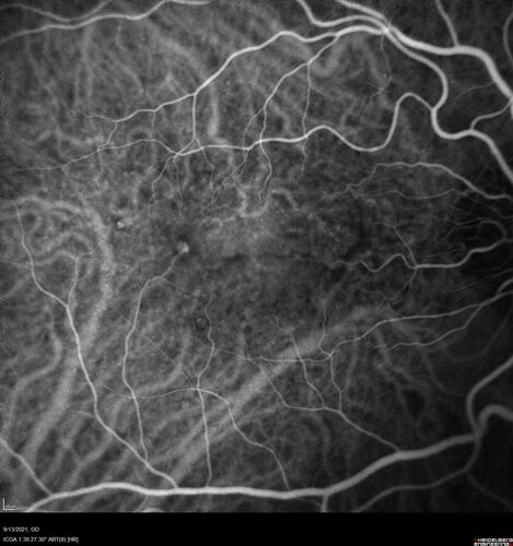 Asymptomatic exudative wet age-related macular degeneration
78 year old man with scar in the left eye being treated regularly and returns with new lesions in the right eye which is not symptomatic.  Vision is 20/25 right eye and 20/125 left eye.  The lesion was treated and responded to anti-VEGF therapy
