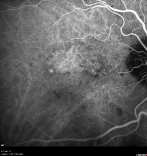 Asymptomatic exudative wet age-related macular degeneration
78 year old man with scar in the left eye being treated regularly and returns with new lesions in the right eye which is not symptomatic.  Vision is 20/25 right eye and 20/125 left eye.  The lesion was treated and responded to anti-VEGF therapy
