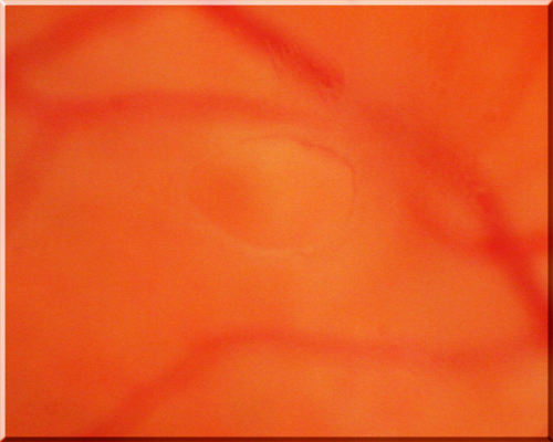 Acute Posterior Vitreous Detachment - Weiss Ring - Vogt Ring
