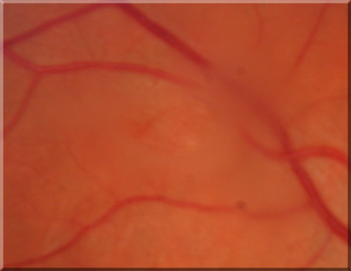 Acute Posterior Vitreous Detachment - Weiss Ring - Vogt Ring
