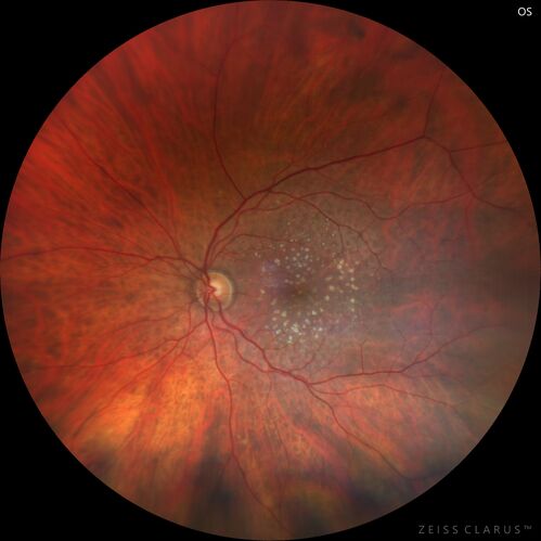 Wet age-related macular degeneration - Classic Juxtafoveal Choroidal Neovascular Membrane
80 year old female with mild vision loss.  20/40 OD, 20/25 OS.  Avastin controlled disease.  VA improved to 20/25 after 2 injections.  At 1 year she is getting every 2 months treatment
