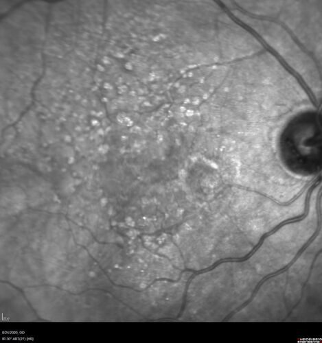 Wet age-related macular degeneration - Classic Juxtafoveal Choroidal Neovascular Membrane
80 year old female with mild vision loss.  20/40 OD, 20/25 OS.  Avastin controlled disease.  VA improved to 20/25 after 2 injections.  At 1 year she is getting every 2 months treatment
