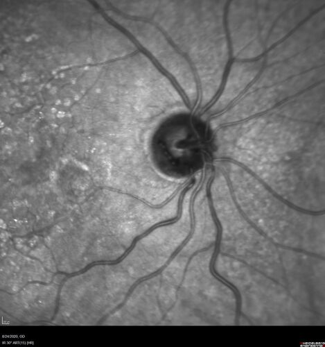 Wet age-related macular degeneration - Classic Juxtafoveal Choroidal Neovascular Membrane
80 year old female with mild vision loss.  20/40 OD, 20/25 OS.  Avastin controlled disease.  VA improved to 20/25 after 2 injections.  At 1 year she is getting every 2 months treatment
