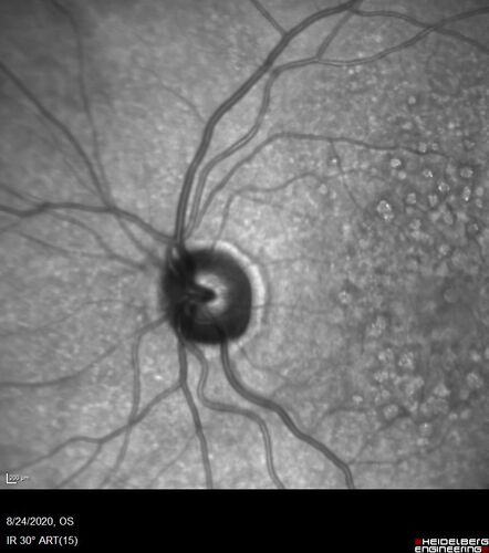 Wet age-related macular degeneration - Classic Juxtafoveal Choroidal Neovascular Membrane
80 year old female with mild vision loss.  20/40 OD, 20/25 OS.  Avastin controlled disease.  VA improved to 20/25 after 2 injections.  At 1 year she is getting every 2 months treatment
