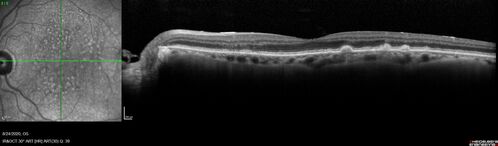 Wet age-related macular degeneration - Classic Juxtafoveal Choroidal Neovascular Membrane
80 year old female with mild vision loss.  20/40 OD, 20/25 OS.  Avastin controlled disease.  VA improved to 20/25 after 2 injections.  At 1 year she is getting every 2 months treatment
