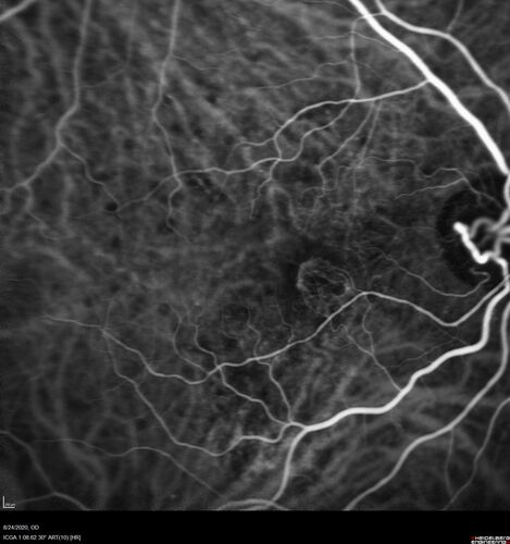 Wet age-related macular degeneration - Classic Juxtafoveal Choroidal Neovascular Membrane
80 year old female with mild vision loss.  20/40 OD, 20/25 OS.  Avastin controlled disease.  VA improved to 20/25 after 2 injections.  At 1 year she is getting every 2 months treatment
