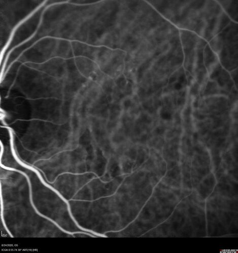 Wet age-related macular degeneration - Classic Juxtafoveal Choroidal Neovascular Membrane
80 year old female with mild vision loss.  20/40 OD, 20/25 OS.  Avastin controlled disease.  VA improved to 20/25 after 2 injections.  At 1 year she is getting every 2 months treatment
