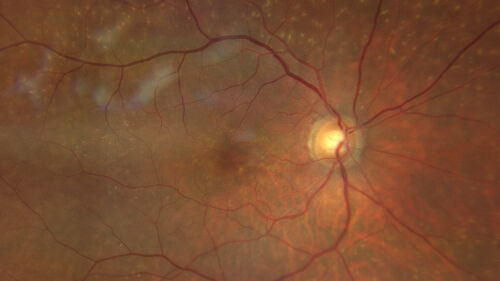 Post Anti-VEGF RPE Tear (Vabysmo)
87 year  old female with vision loss OS (20/125) given 1/4 dose vabysmo and developed RPE tear VA dropped to 20/400
