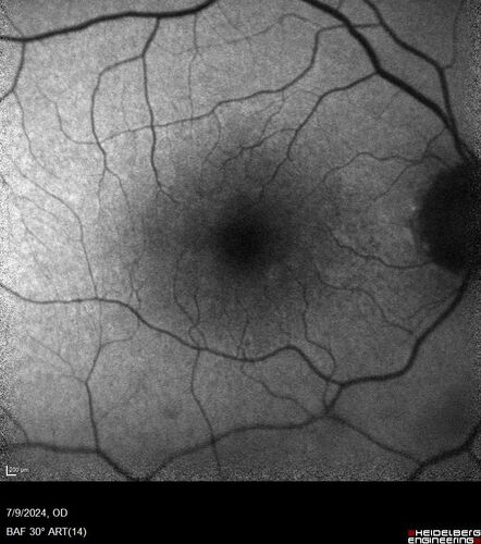 Post Anti-VEGF RPE Tear (Vabysmo)
87 year  old female with vision loss OS (20/125) given 1/4 dose vabysmo and developed RPE tear VA dropped to 20/400
