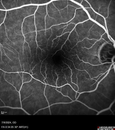 Post Anti-VEGF RPE Tear (Vabysmo)
87 year  old female with vision loss OS (20/125) given 1/4 dose vabysmo and developed RPE tear VA dropped to 20/400
