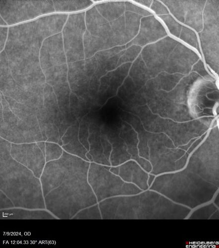 Post Anti-VEGF RPE Tear (Vabysmo)
87 year  old female with vision loss OS (20/125) given 1/4 dose vabysmo and developed RPE tear VA dropped to 20/400
