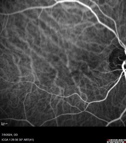 Post Anti-VEGF RPE Tear (Vabysmo)
87 year  old female with vision loss OS (20/125) given 1/4 dose vabysmo and developed RPE tear VA dropped to 20/400
