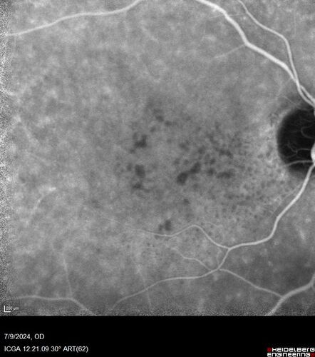 Post Anti-VEGF RPE Tear (Vabysmo)
87 year  old female with vision loss OS (20/125) given 1/4 dose vabysmo and developed RPE tear VA dropped to 20/400
