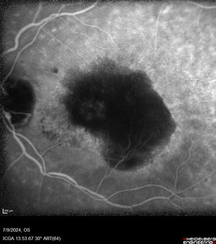 Post Anti-VEGF RPE Tear (Vabysmo)
87 year  old female with vision loss OS (20/125) given 1/4 dose vabysmo and developed RPE tear VA dropped to 20/400
