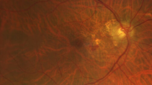 wet AMD - extrafoveal classic choroidal neovascular membrane
72 year old man with good vision in both eyes.  Extrafoveal classic cnvm was picked up and treated with vabysmo
