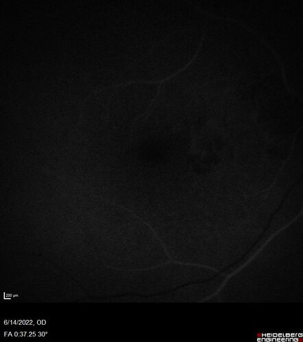 wet AMD - extrafoveal classic choroidal neovascular membrane
72 year old man with good vision in both eyes.  Extrafoveal classic cnvm was picked up and treated with vabysmo
