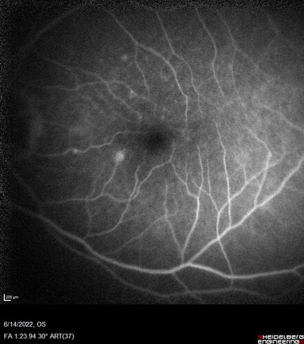 wet AMD - extrafoveal classic choroidal neovascular membrane
72 year old man with good vision in both eyes.  Extrafoveal classic cnvm was picked up and treated with vabysmo
