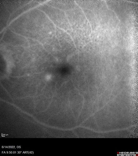 wet AMD - extrafoveal classic choroidal neovascular membrane
72 year old man with good vision in both eyes.  Extrafoveal classic cnvm was picked up and treated with vabysmo

