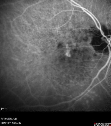 wet AMD - extrafoveal classic choroidal neovascular membrane
72 year old man with good vision in both eyes.  Extrafoveal classic cnvm was picked up and treated with vabysmo
