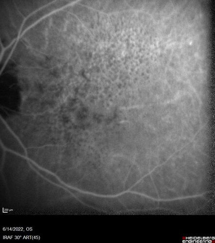 wet AMD - extrafoveal classic choroidal neovascular membrane
72 year old man with good vision in both eyes.  Extrafoveal classic cnvm was picked up and treated with vabysmo
