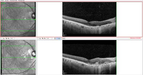 wet AMD - extrafoveal classic choroidal neovascular membrane
72 year old man with good vision in both eyes.  Extrafoveal classic cnvm was picked up and treated with vabysmo
