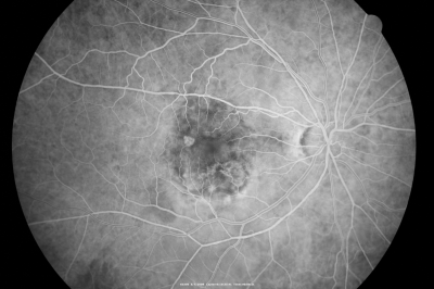 Wet AMD - Subfoveal CNVM - Excellent Response to Avastin
76-year-old woman two to three months of vision loss OD

Vision started at 20/200 and with Avastin improved to 20/25.  She has required monthly injections and as of October 2010 has been treated about 16 times.  Her left eye remains good at 20/20. 

The OCT from post-treatment as well as pretreatment images are in this album.
