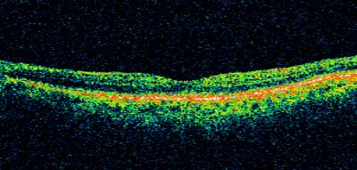Wet AMD - Subfoveal CNVM - Excellent Response to Avastin
76-year-old woman two to three months of vision loss OD

Vision started at 20/200 and with Avastin improved to 20/25.  She has required monthly injections and as of October 2010 has been treated about 16 times.  Her left eye remains good at 20/20. 

The OCT from post-treatment as well as pretreatment images are in this album.
