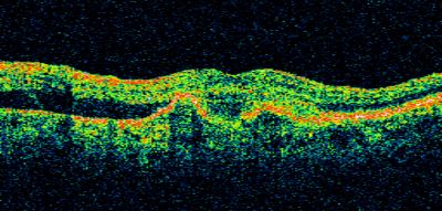 Wet AMD - Subfoveal CNVM - Excellent Response to Avastin
76-year-old woman two to three months of vision loss OD

Vision started at 20/200 and with Avastin improved to 20/25.  She has required monthly injections and as of October 2010 has been treated about 16 times.  Her left eye remains good at 20/20. 

The OCT from post-treatment as well as pretreatment images are in this album.
